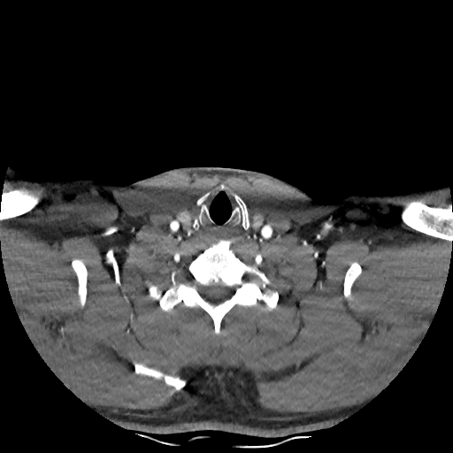 Buccal fat pad arteriovenous malformation (Radiopaedia 70936-81144 D 75).jpg