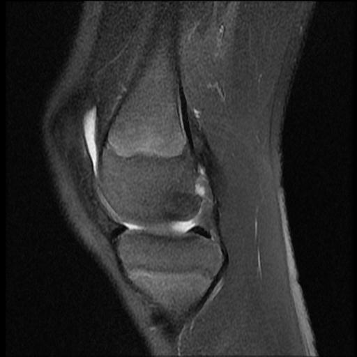 File:Bucket handle tear - lateral meniscus (Radiopaedia 72124-82634 Sagittal PD fat sat 11).jpg
