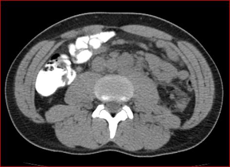 File:Burned-out testicular choriocarcinoma (Radiopaedia 32822-34040 Axial non-contrast 14).jpg