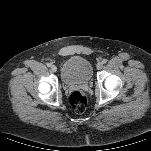 Burned-out testicular seminoma - retroperitoneal nodal metastases (Radiopaedia 62872-71245 A 67).jpg