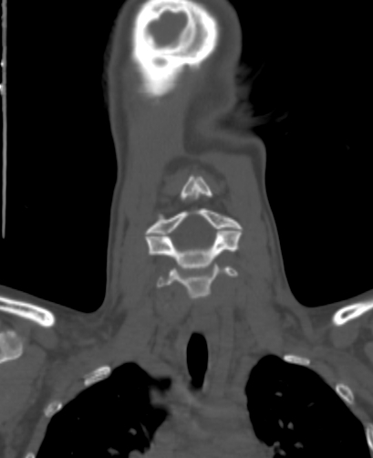 Butterfly vertebra (Radiopaedia 77903-90209 Coronal bone window 13).jpg