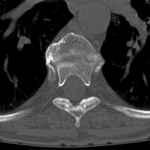 Butterfly vertebrae with kyphoscoliosis (Radiopaedia 14257-14133 Axial bone window 18).jpg
