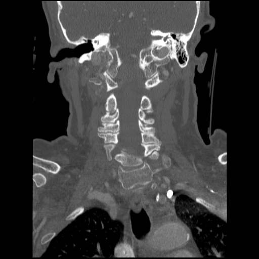 File:C1 anterior arch (plough) fracture - type 1 (Radiopaedia 76181-87720 Coronal bone window 48).jpg