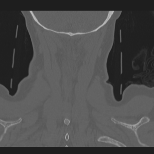 C2 fracture (Radiopaedia 34091-35341 Coronal bone window 53).png