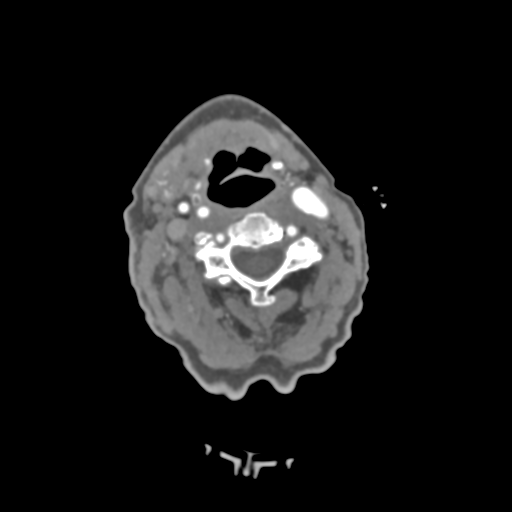 C2 fracture with vertebral artery dissection (Radiopaedia 37378-39200 A 142).png