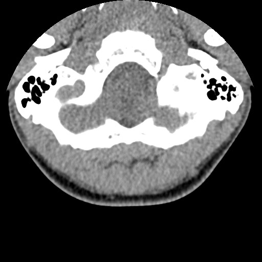 C5 facet fracture (Radiopaedia 58374-65499 Axial non-contrast 4).jpg