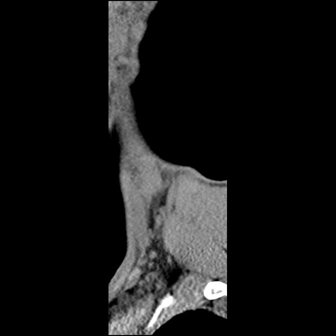 C5 facet fracture (Radiopaedia 58374-65499 D 4).jpg