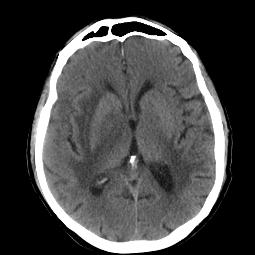 File:CNS lymphoma (Radiopaedia 36983-38639 Axial non-contrast 20).png