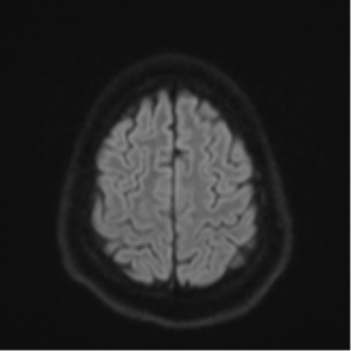 File:CNS vasculitis (Radiopaedia 55715-62263 Axial DWI 54).png