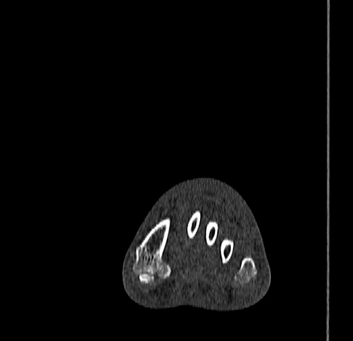 Calcaneal fracture - Sanders type 4 (Radiopaedia 90179-107370 Coronal bone window 31).jpg