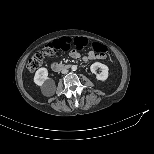 Calcified adrenal glands and Spigelian hernia (Radiopaedia 49741-54988 A 110).jpg