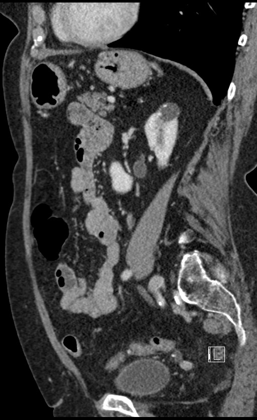 Calcified adrenal glands and Spigelian hernia (Radiopaedia 49741-54988 C 57).jpg