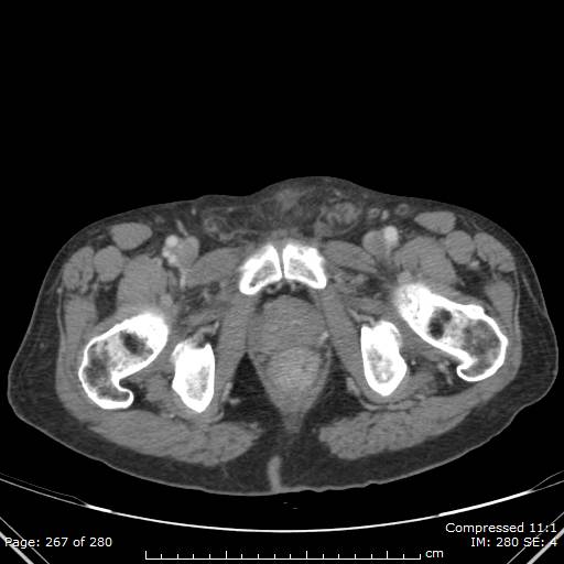Calcified liver metastases (Radiopaedia 44699-48470 B 66).jpg