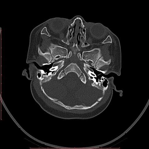 Calcified middle cerebral artery embolism (Radiopaedia 78949-91860 Axial bone window 2).jpg