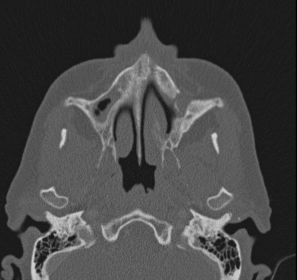 Caldwell-Luc operation (Radiopaedia 52329-58225 Axial bone window 39).jpg
