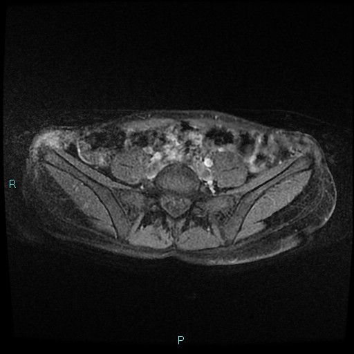 File:Canal of Nuck cyst (Radiopaedia 55074-61448 Axial T1 C+ fat sat 2).jpg
