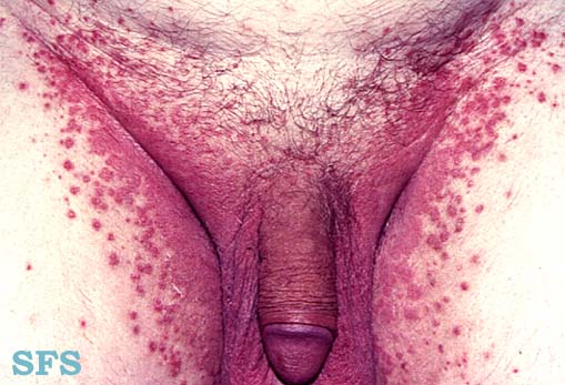 File:Candidiasis (Dermatology Atlas 1).jpg