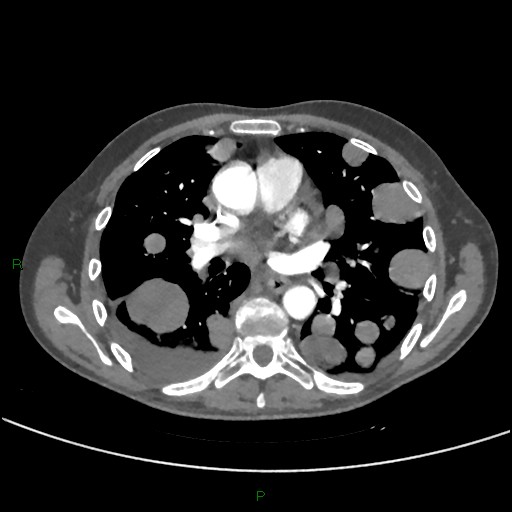 Cannonball metastases (Radiopaedia 82110-96150 Axial C+ CTPA 169).jpg