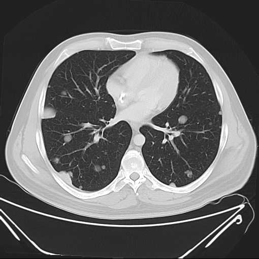 File:Cannonball pulmonary metastases (Radiopaedia 67684-77101 B 15).jpg