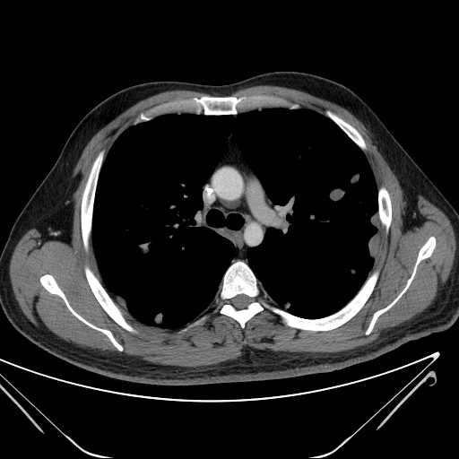 File:Cannonball pulmonary metastases (Radiopaedia 67684-77101 D 108).jpg