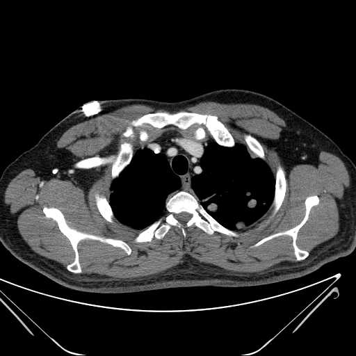 File:Cannonball pulmonary metastases (Radiopaedia 67684-77101 D 47).jpg