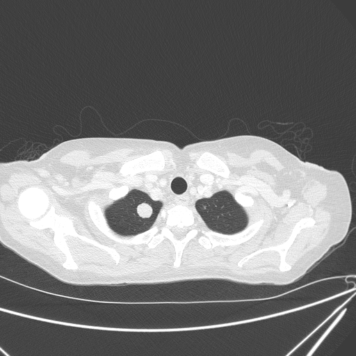 Canonball lung metastasis (Radiopaedia 77634-89837 Axial lung window 19).jpg