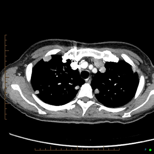 Canonball lung metastasis (Radiopaedia 77634-89837 B 19).jpg