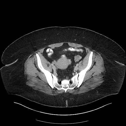 Carcinoid tumor - terminal ileum (Radiopaedia 60931-68739 A 106).jpg