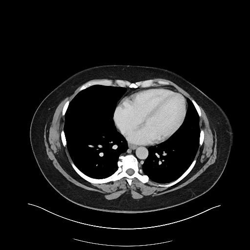 Carcinoid tumor - terminal ileum (Radiopaedia 60931-68739 A 3).jpg