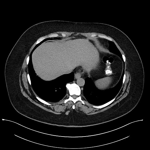 File:Carcinoid tumor - terminal ileum (Radiopaedia 60931-68740 Axial non-contrast 5).jpg