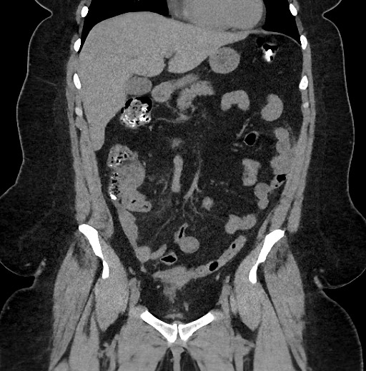 Carcinoid tumor - terminal ileum (Radiopaedia 60931-68740 Coronal non-contrast 35).jpg