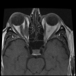 File:Carcinoid tumor of the ileum with metastasis to orbit (Radiopaedia 28165-28424 Axial T1 3).jpg