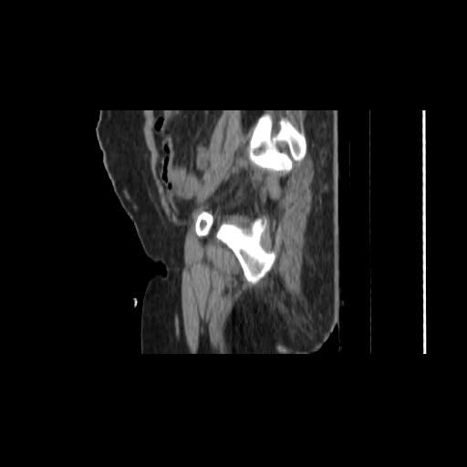 Carcinoma cervix- brachytherapy applicator (Radiopaedia 33135-34173 D 36).jpg