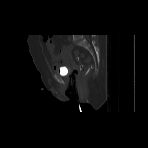 Carcinoma cervix- brachytherapy applicator (Radiopaedia 33135-34173 Sagittal bone window 96).jpg