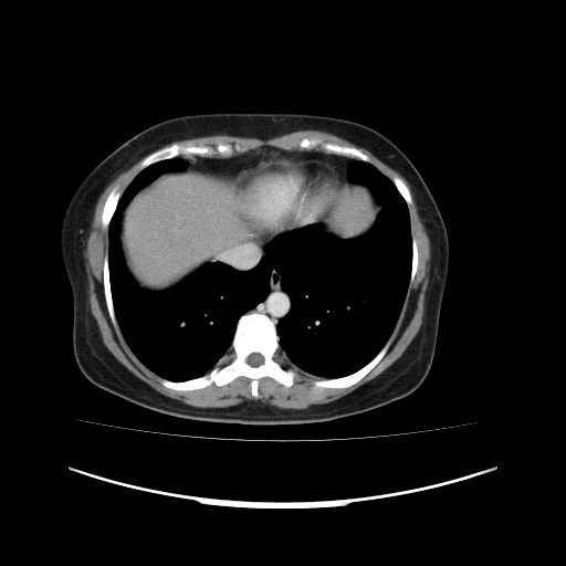 File:Carcinoma colon - hepatic flexure (Radiopaedia 19461-19493 A 14).jpg