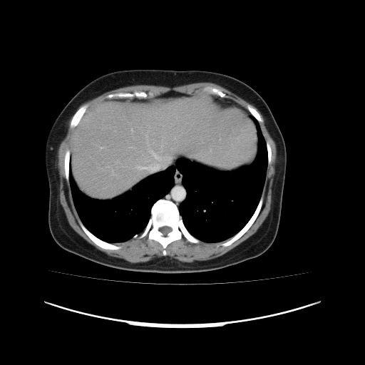 Carcinoma colon - hepatic flexure (Radiopaedia 19461-19493 A 17).jpg