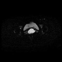 Carcinoma of the cervix (Radiopaedia 89018-105858 Axial DWI 31).jpg