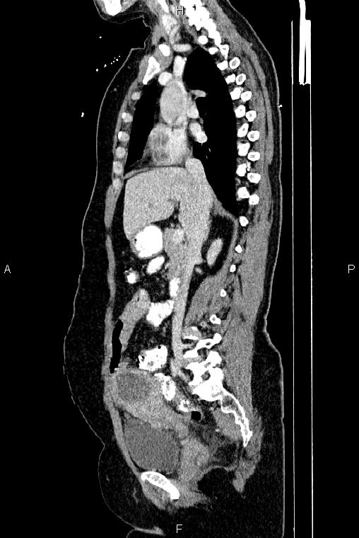 Carcinoma of uterine cervix (Radiopaedia 85861-101700 D 34).jpg