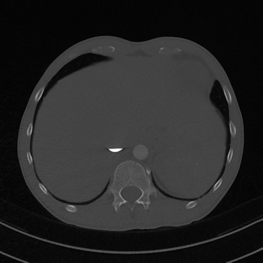 File:Cardiac tumor - undifferentiated pleomorphic sarcoma (Radiopaedia 45844-50134 Axial bone window 62).png