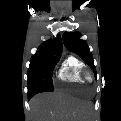 Cardiac tumor - undifferentiated pleomorphic sarcoma (Radiopaedia 45844-50134 Coronal non-contrast 12).png