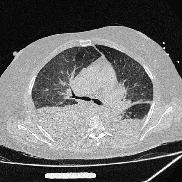 Cardiogenic pulmonary edema (Radiopaedia 29213-29609 Axial lung window 37).jpg