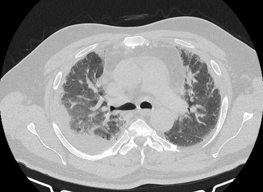 Cardiogenic pulmonary edema (Radiopaedia 68180-77678 Axial lung window 32).jpg