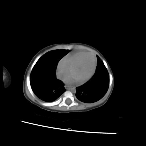 File:Caroli disease with autosomal recessive polycystic kidney disease (ARPKD) (Radiopaedia 89651-106703 Axial non-contrast 1).jpg