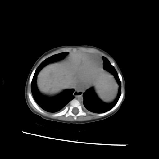 File:Caroli disease with autosomal recessive polycystic kidney disease (ARPKD) (Radiopaedia 89651-106703 Axial non-contrast 4).jpg