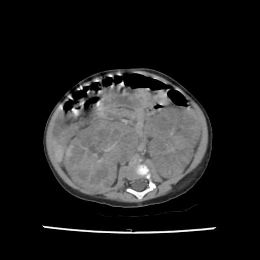 Caroli disease with autosomal recessive polycystic kidney disease (ARPKD) (Radiopaedia 89651-106703 B 132).jpg