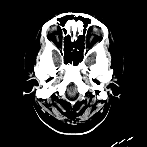 File:Carotico ophthalmic aneurysm (Radiopaedia 42916-46147 Axial non-contrast 1).png