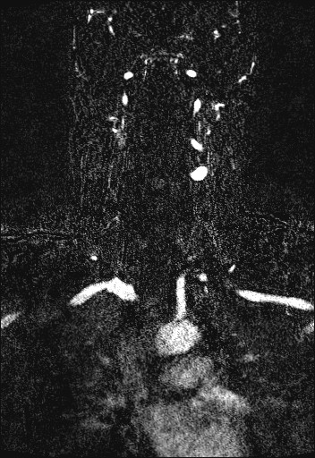 Carotid artery dissection (Radiopaedia 28441-28689 Coronal MRA 44).jpg