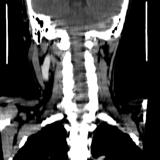 File:Carotid body tumor (Radiopaedia 27890-28124 B 3).jpg