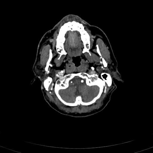 File:Carotid body tumor (Radiopaedia 83615-98727 A 30).jpg
