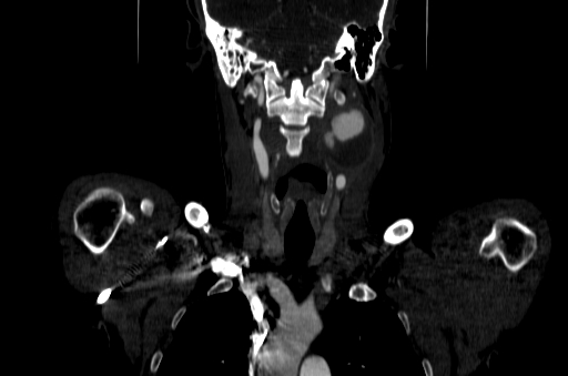 File:Carotid bulb pseudoaneurysm (Radiopaedia 57670-64616 D 31).jpg